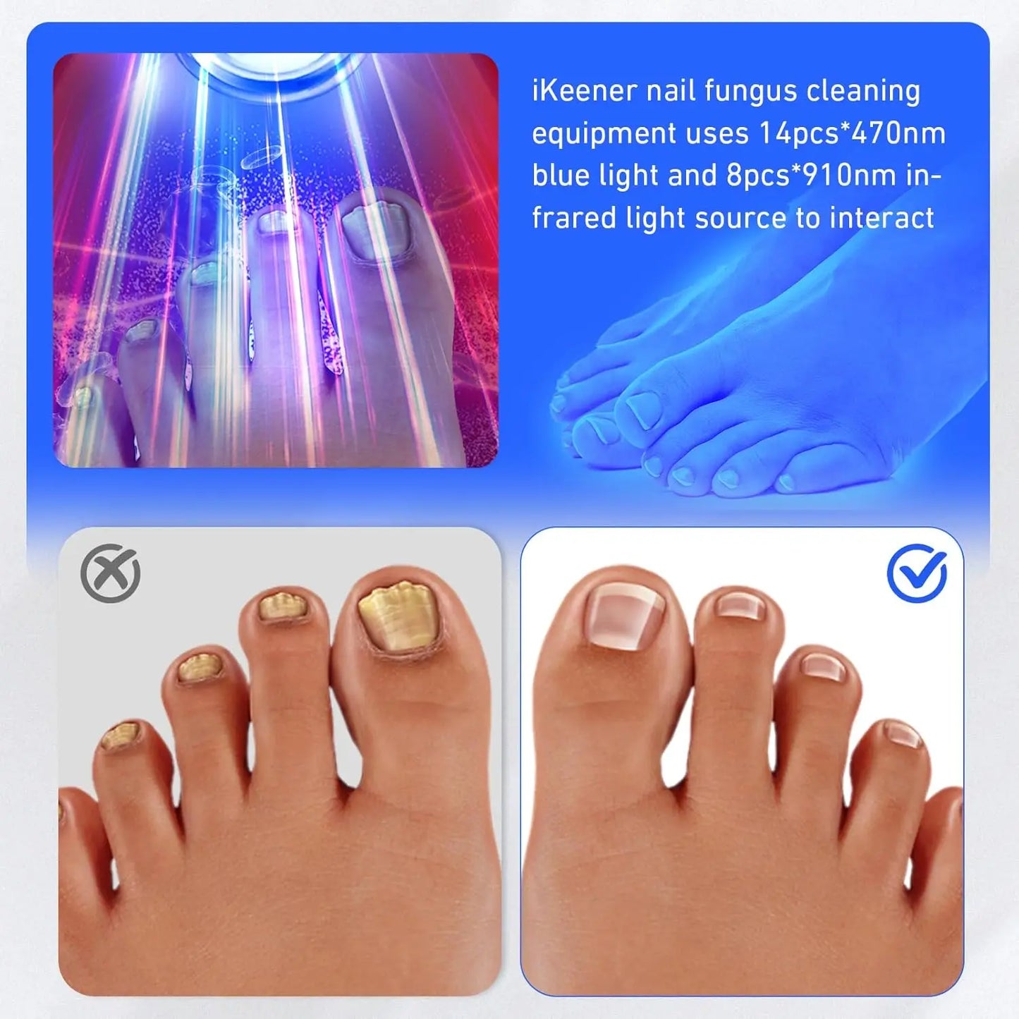 Blue Light Anti Fungal Laser