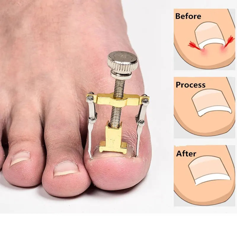 Toenail Correction Bracket