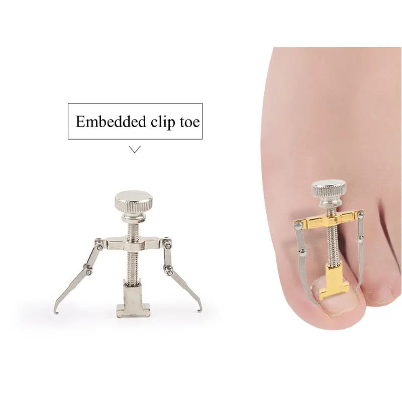 Toenail Correction Bracket